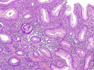 Photomicrograph of Helicobacter pylori infection with chronic active gastritis
